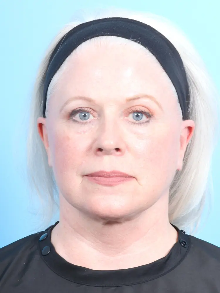 Eyelid Surgery - Case 1924 - After