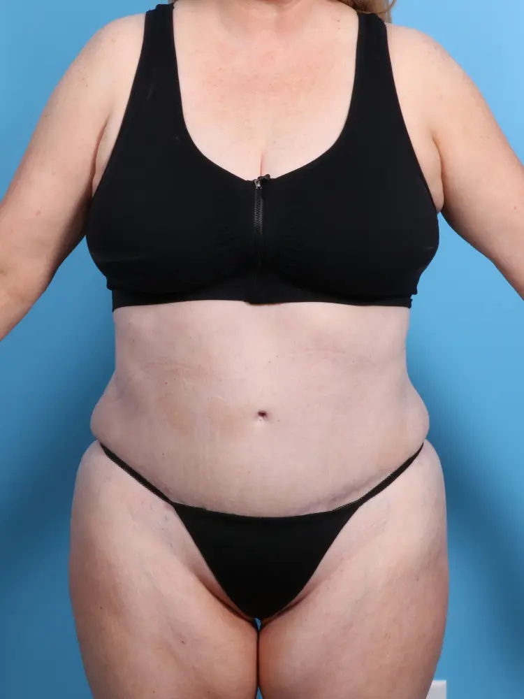 Tummy Tuck - Case 1912 - After