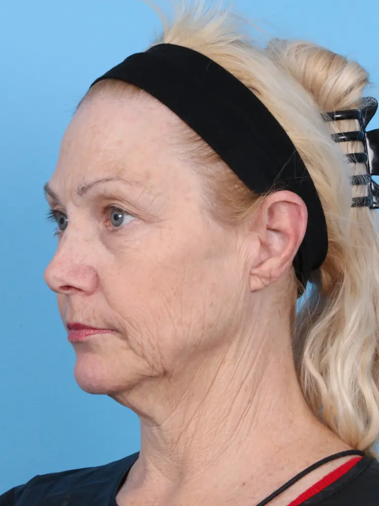 Eyelid Surgery Patient Photo - Case 1920 - before view-1