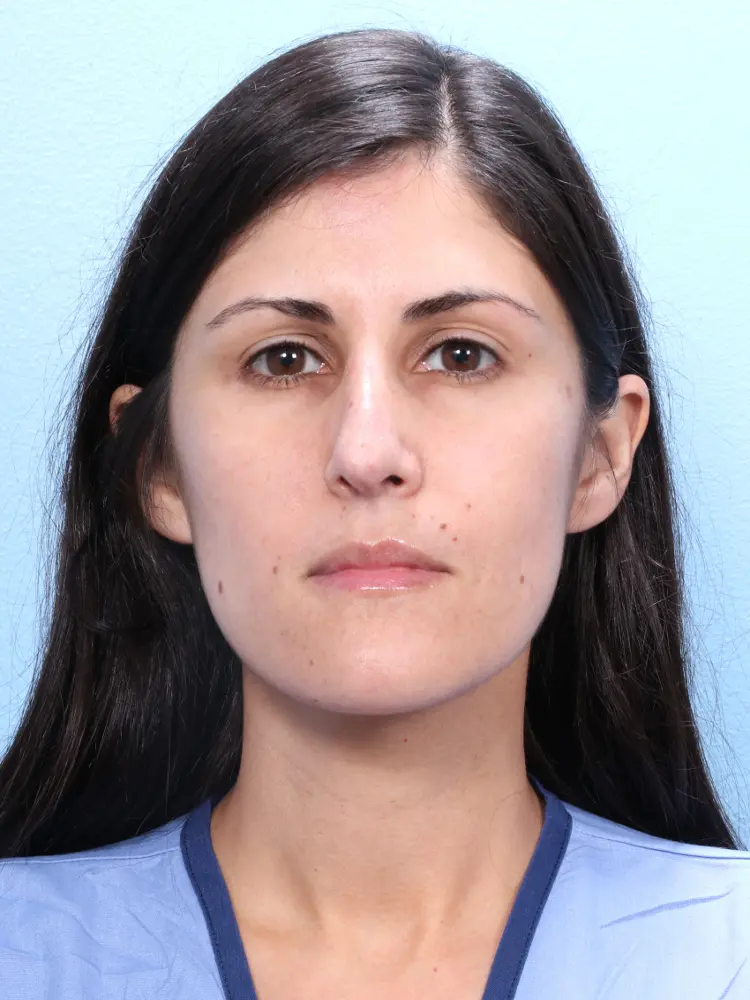Rhinoplasty Patient Photo - Case 1909 - before view-1