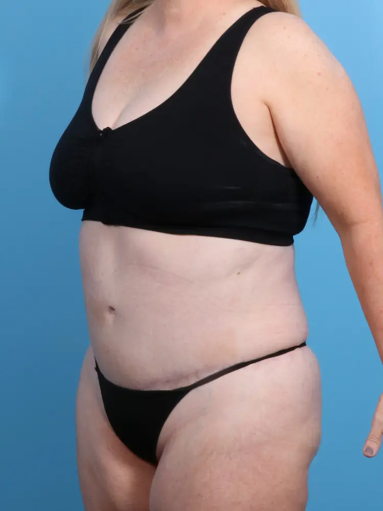 Tummy Tuck Patient Photo - Case 1912 - after view-1