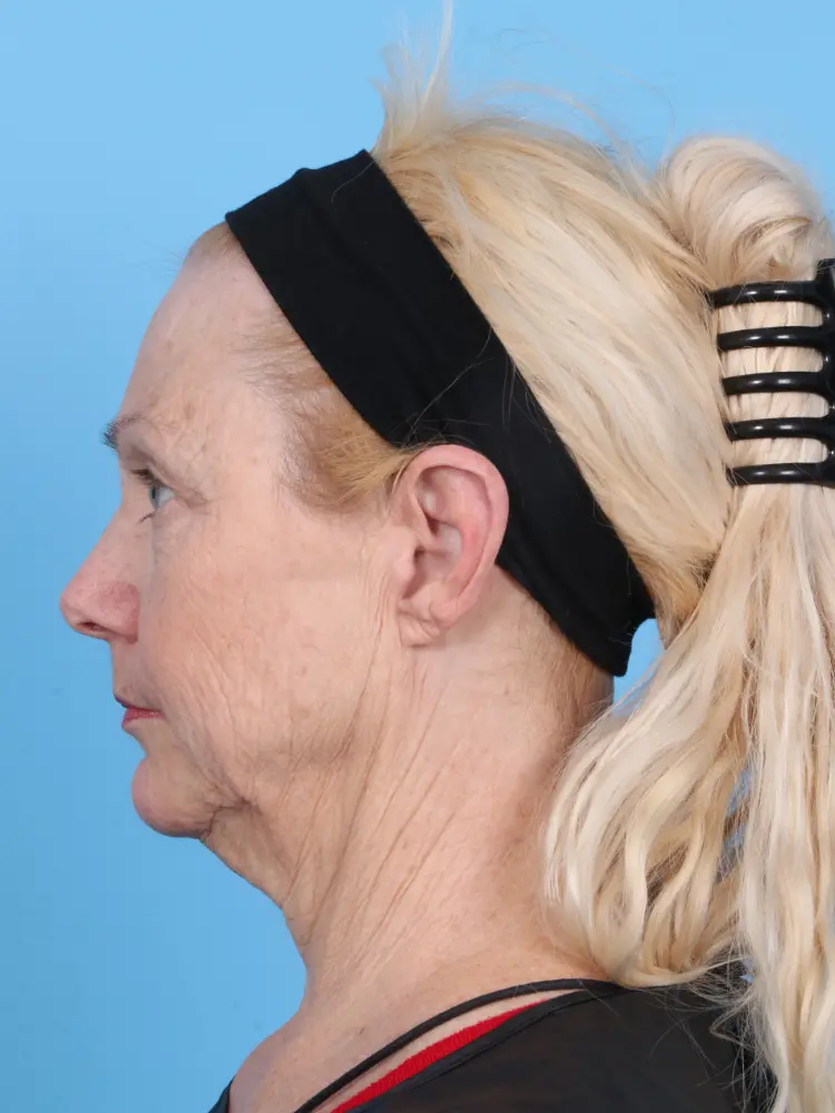 Eyelid Surgery Patient Photo - Case 1920 - before view-2