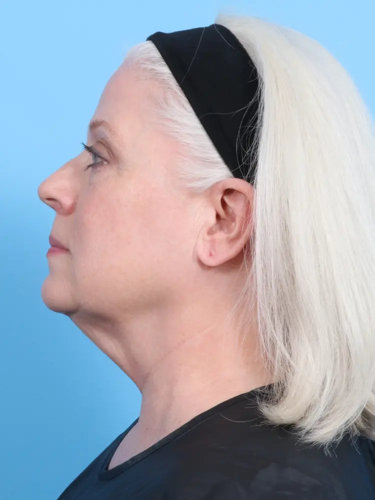 Eyelid Surgery Patient Photo - Case 1924 - before view-2