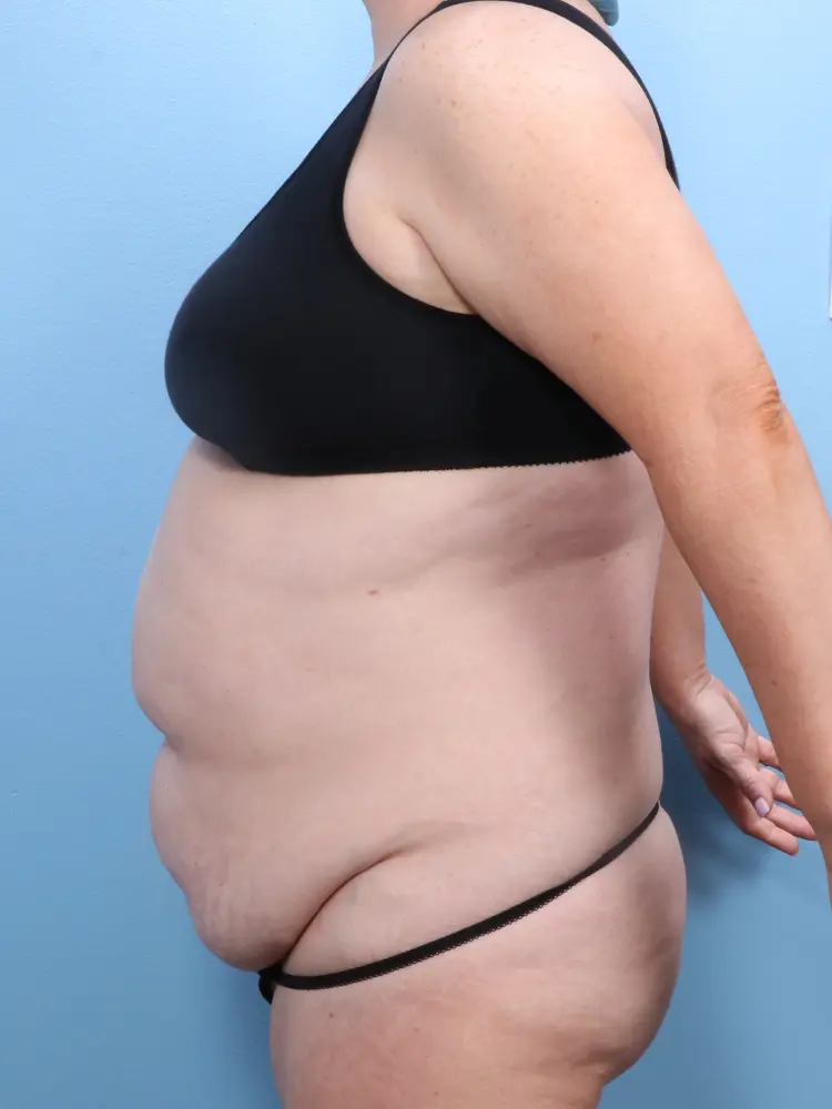 Tummy Tuck Patient Photo - Case 1912 - before view-2