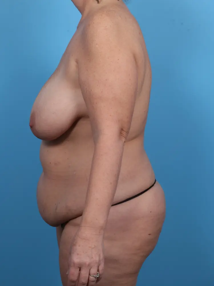 Body Lift Patient Photo - Case 1917 - before view-2