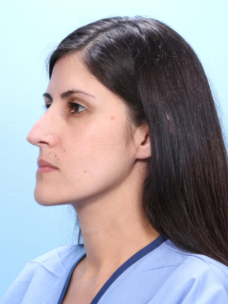 Rhinoplasty Patient Photo - Case 1909 - before view-2