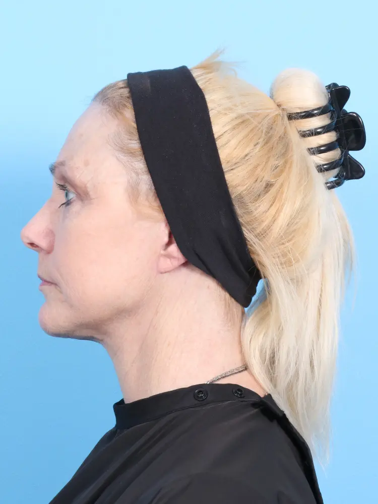 Eyelid Surgery Patient Photo - Case 1920 - after view-2