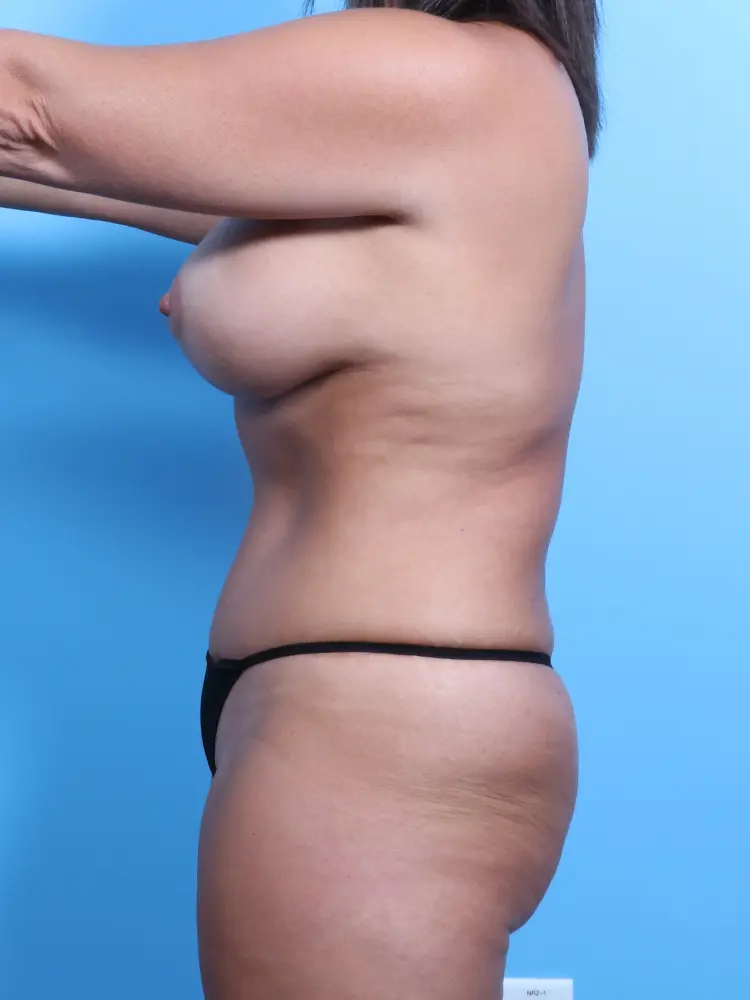 Breast Lift/Reduction with Implants Patient Photo - Case 1911 - after view-2