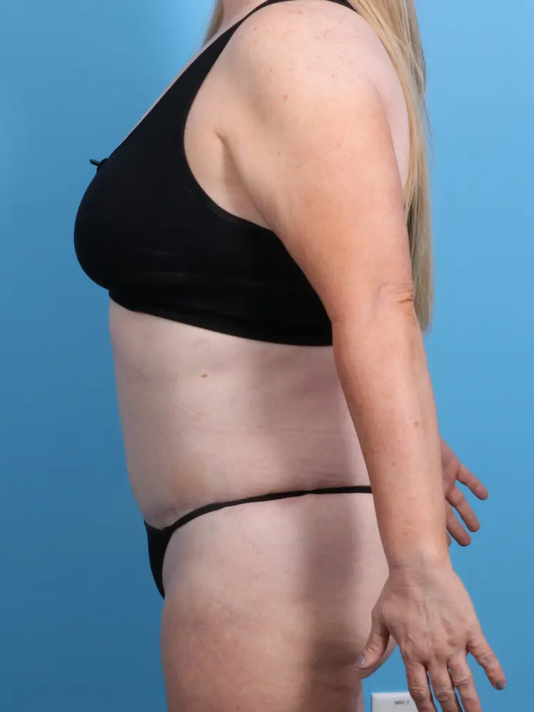 Tummy Tuck Patient Photo - Case 1912 - after view-2