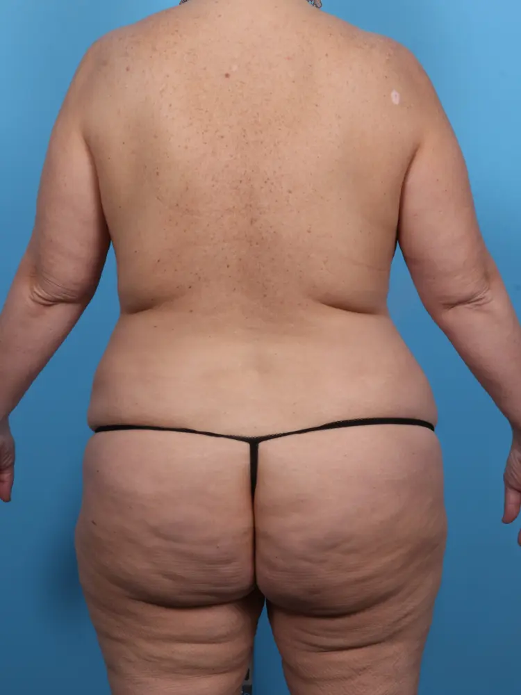 Body Lift Patient Photo - Case 1917 - before view-3