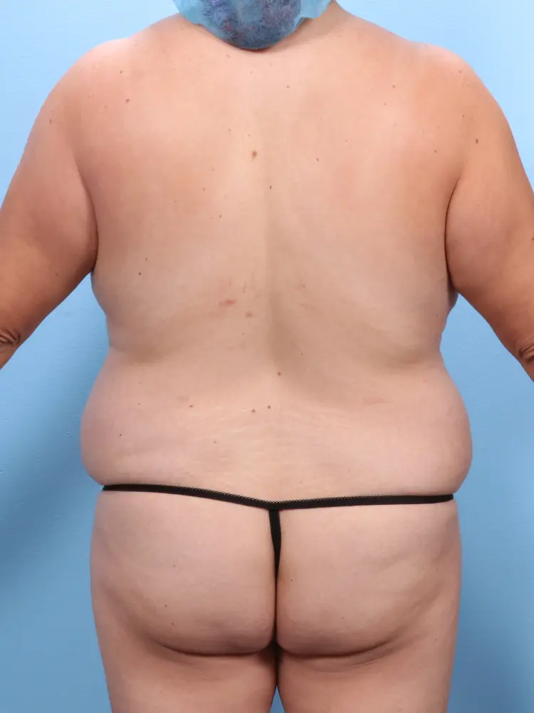 Tummy Tuck Patient Photo - Case 1918 - before view-3
