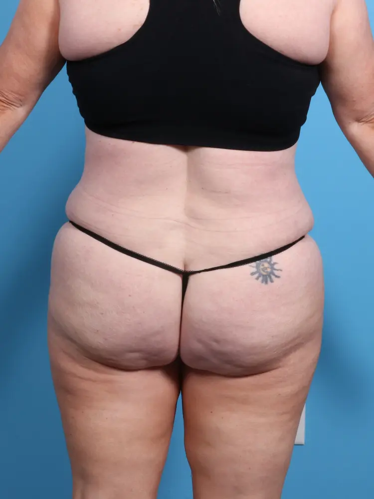 Tummy Tuck Patient Photo - Case 1912 - after view-3