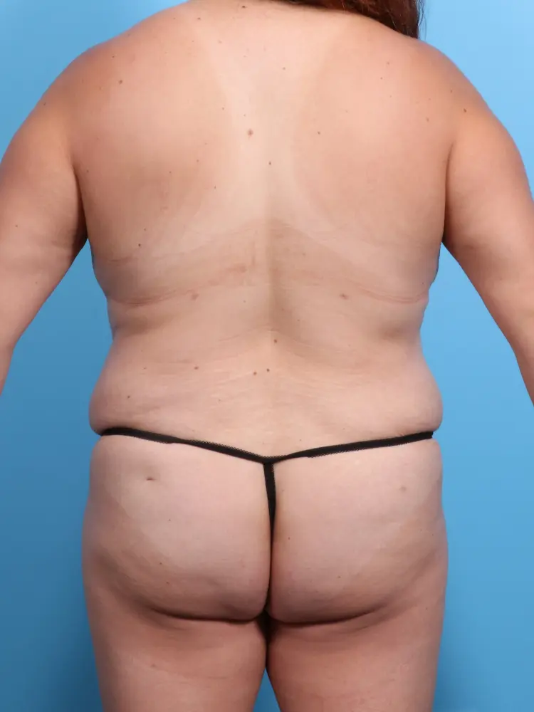 Tummy Tuck Patient Photo - Case 1918 - after view-3