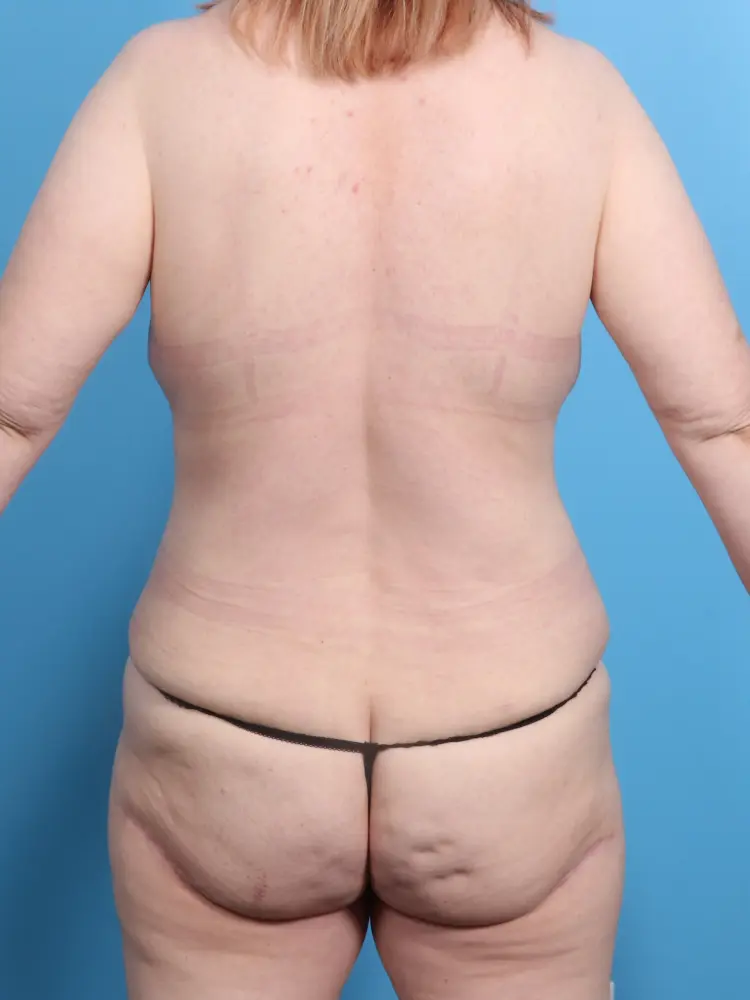 Breast Lift/Reduction w/o Implants Patient Photo - Case 1921 - after view-3