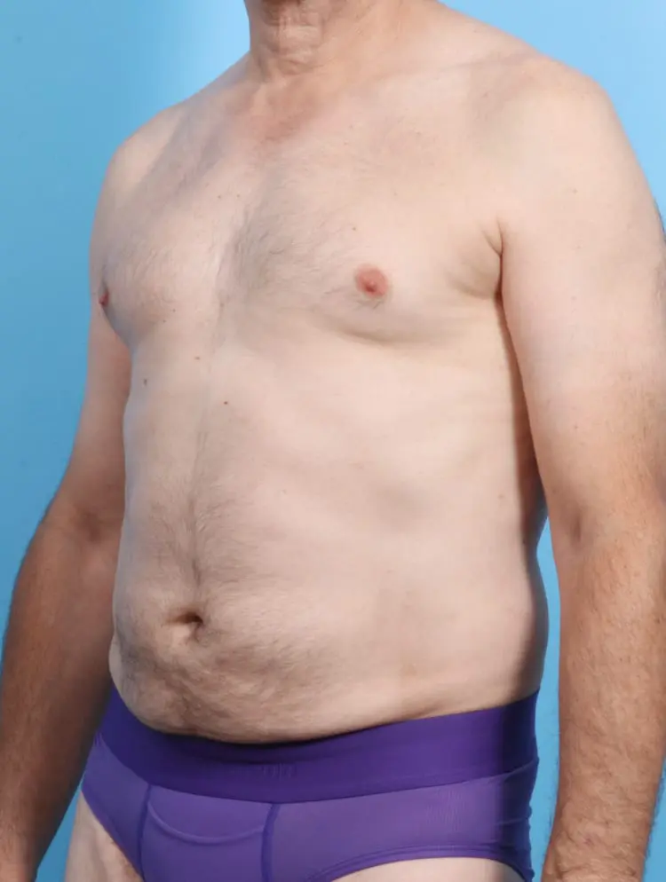 Male Liposuction Patient Photo - Case 16864 - after view-1