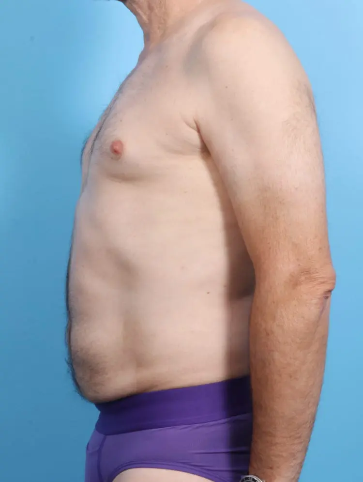 Male Liposuction Patient Photo - Case 16864 - after view-2