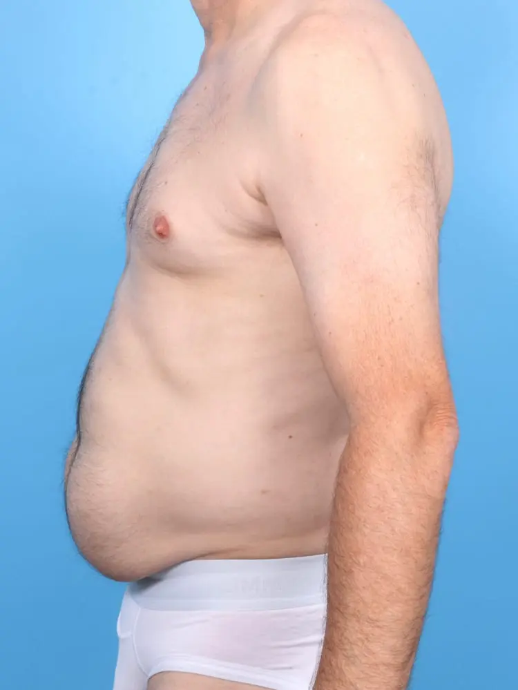 Male Liposuction Patient Photo - Case 16864 - before view-2
