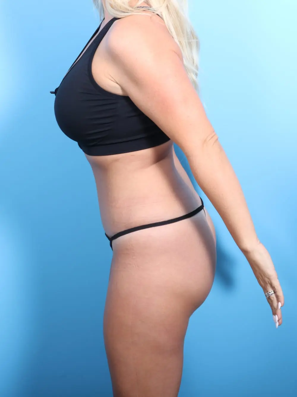 Tummy Tuck Patient Photo - Case 16878 - after view-2