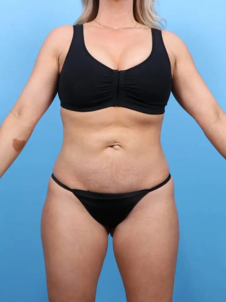 Tummy Tuck - Case 16878 - Before