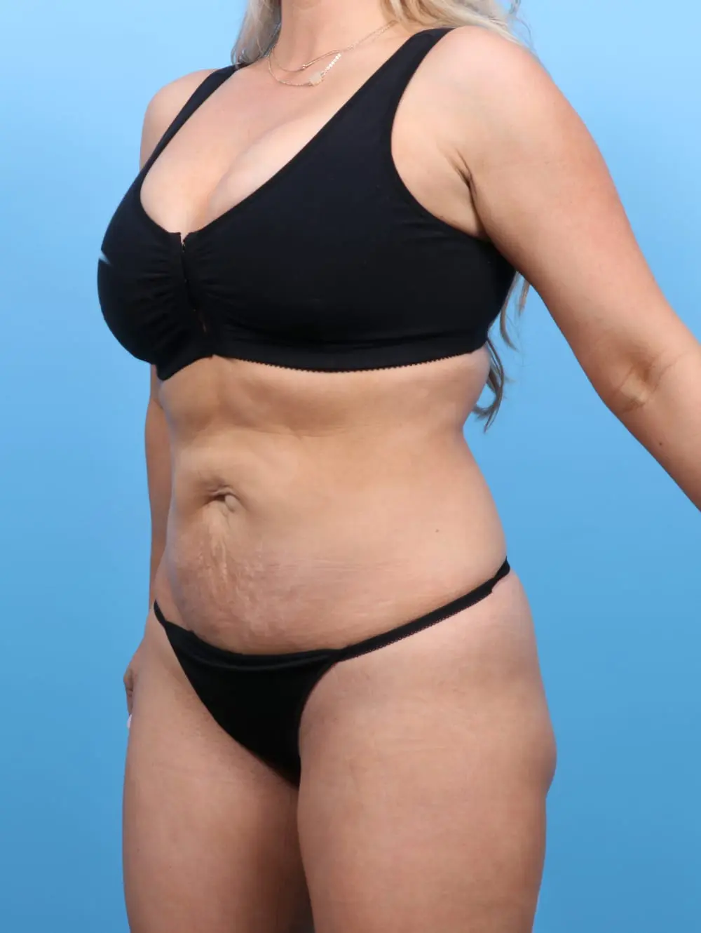 Tummy Tuck Patient Photo - Case 16878 - before view-1