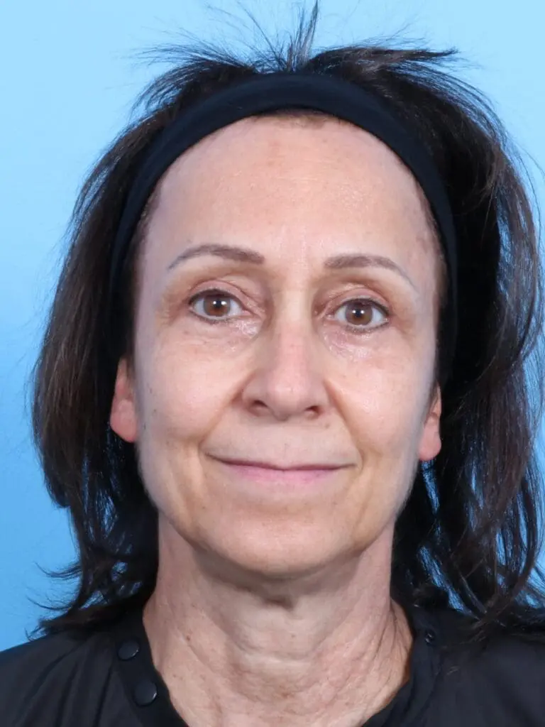 Eyelid Surgery - Case 16900 - After