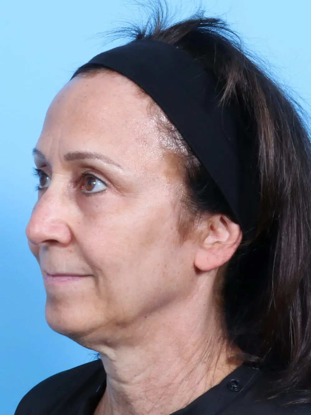 Eyelid Surgery Patient Photo - Case 16900 - after view-1