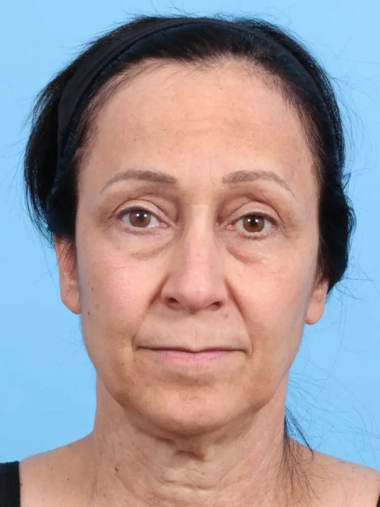 Eyelid Surgery - Case 16900 - Before