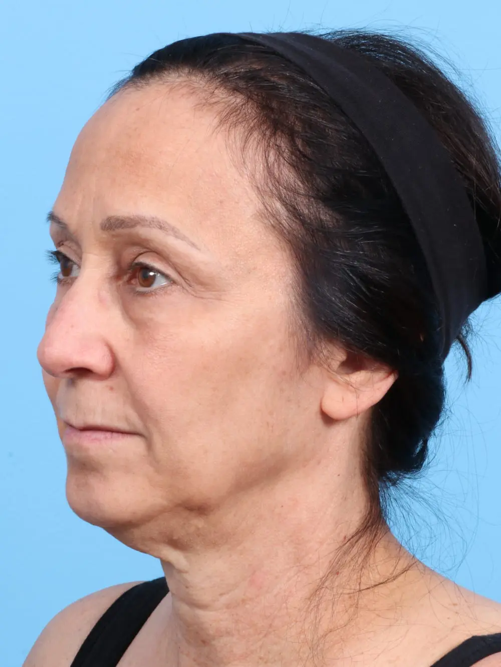 Eyelid Surgery Patient Photo - Case 16900 - before view-1