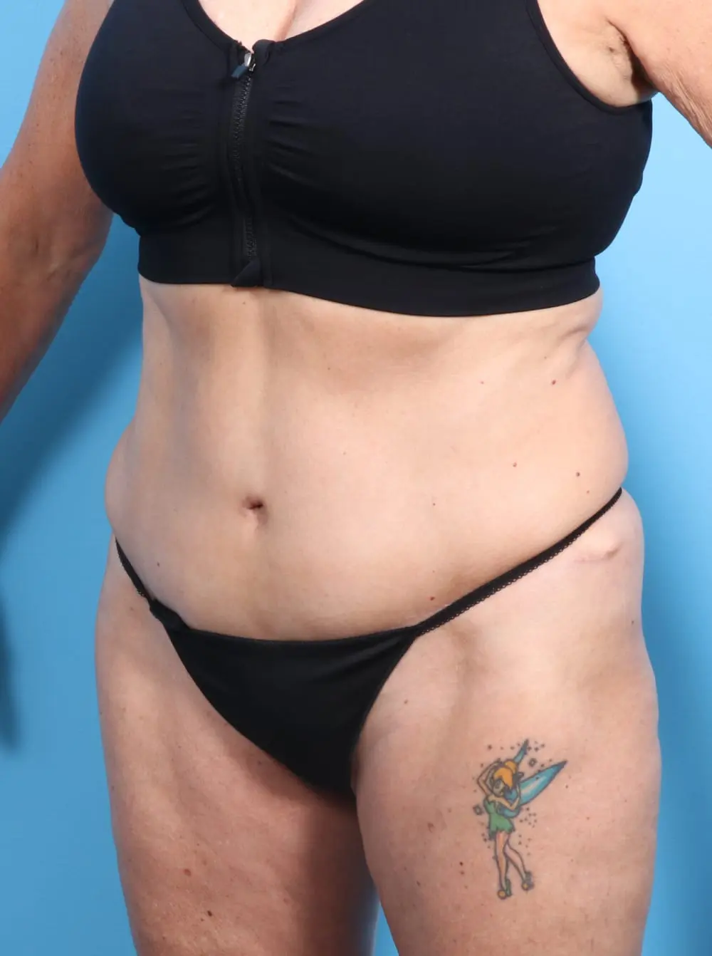 Tummy Tuck Patient Photo - Case 16929 - after view-1