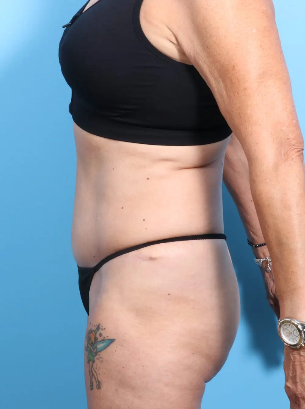 Tummy Tuck Patient Photo - Case 16929 - after view-2