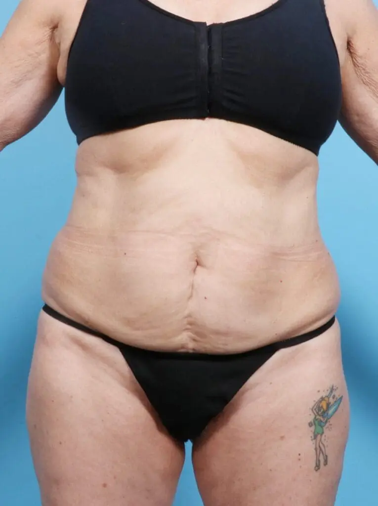 Tummy Tuck - Case 16929 - Before