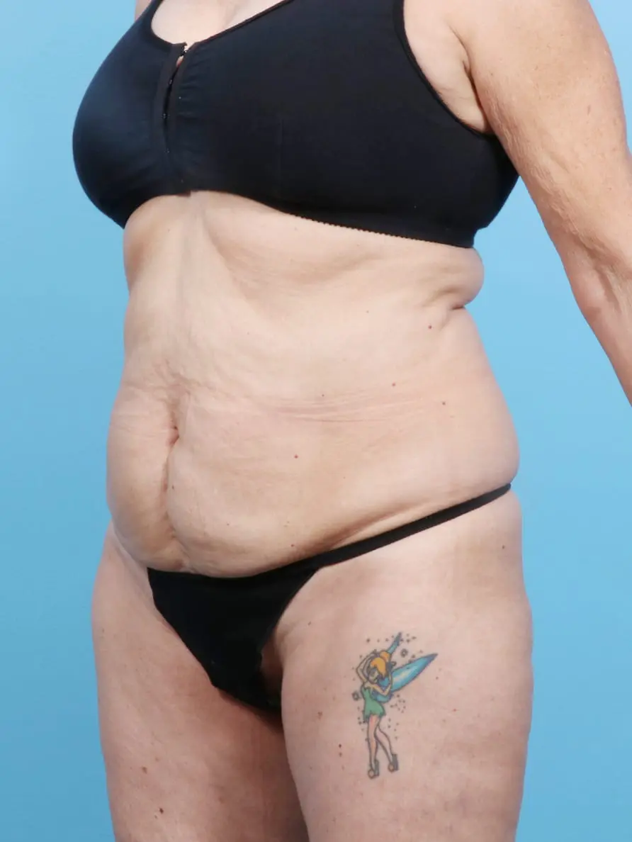Tummy Tuck Patient Photo - Case 16929 - before view-1
