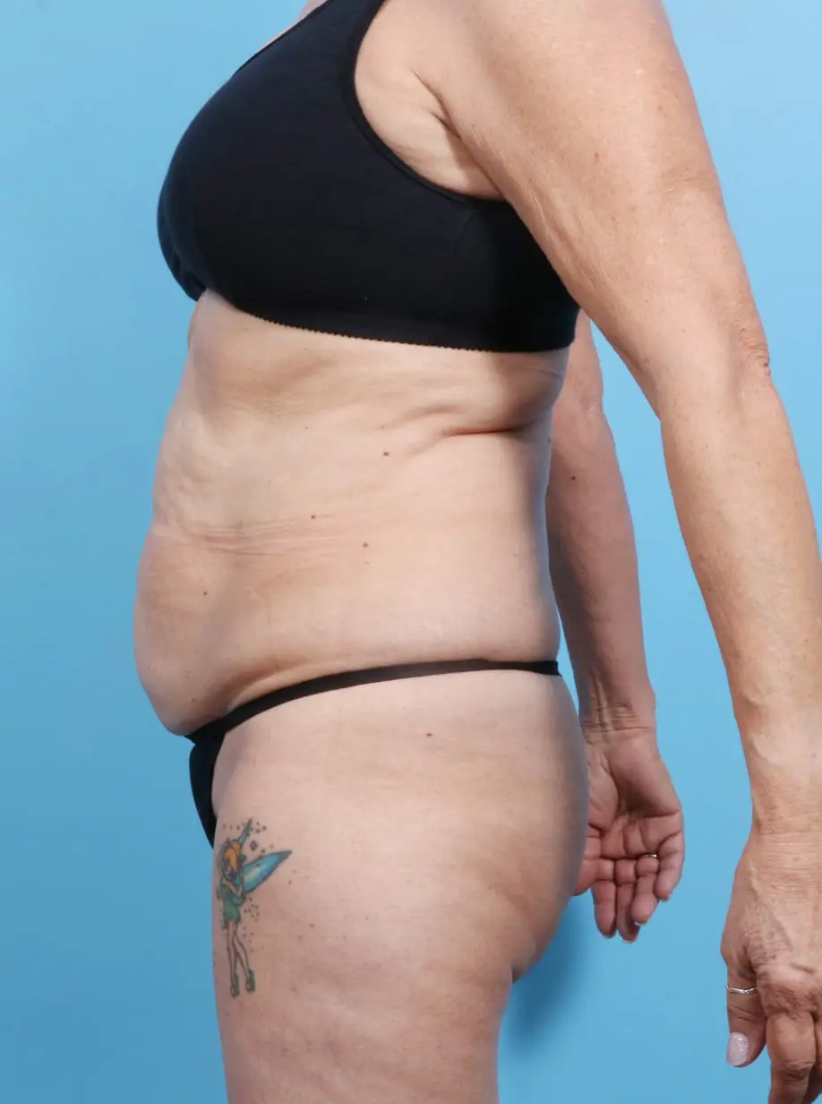 Tummy Tuck Patient Photo - Case 16929 - before view-2