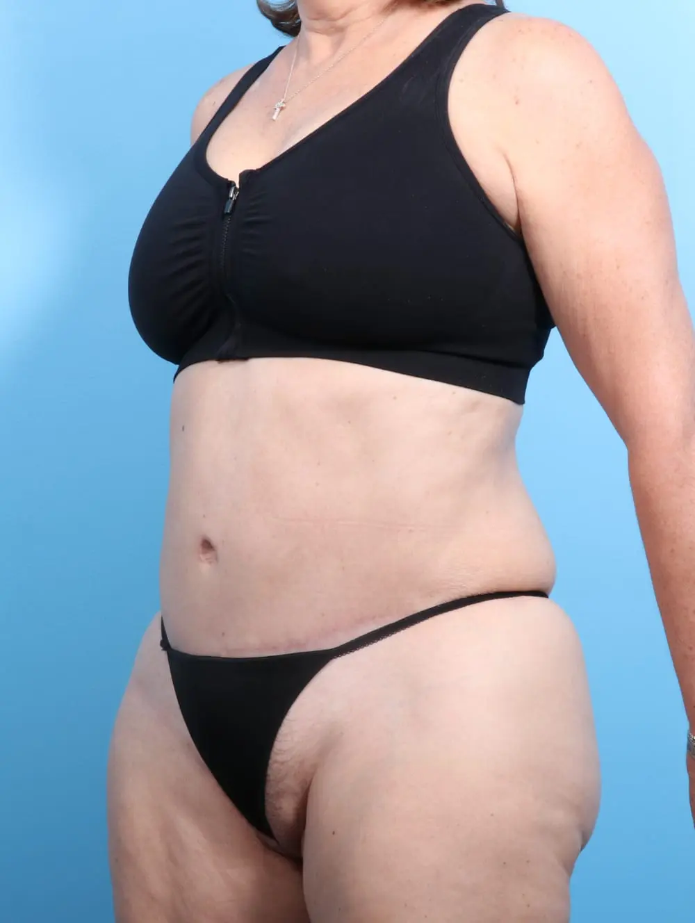 Tummy Tuck Patient Photo - Case 16943 - after view-1