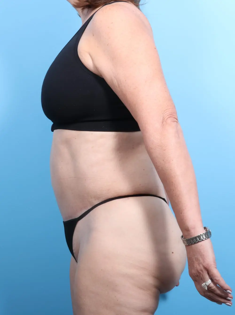 Tummy Tuck Patient Photo - Case 16943 - after view-2