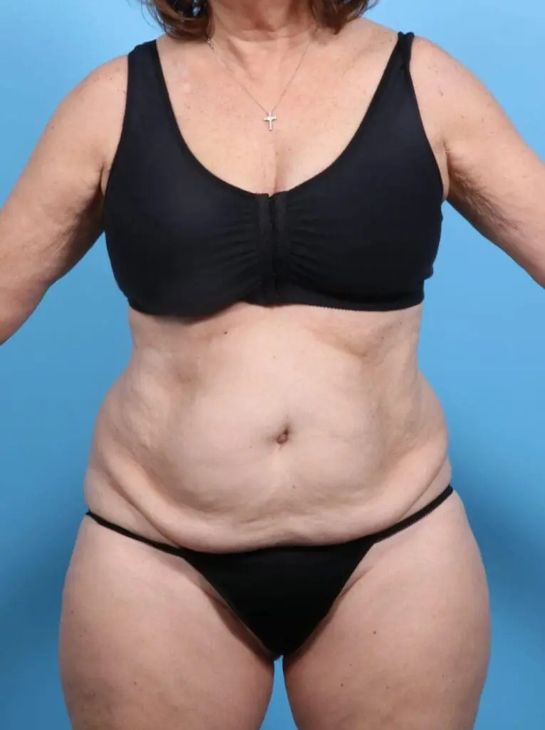 Tummy Tuck - Case 16943 - Before