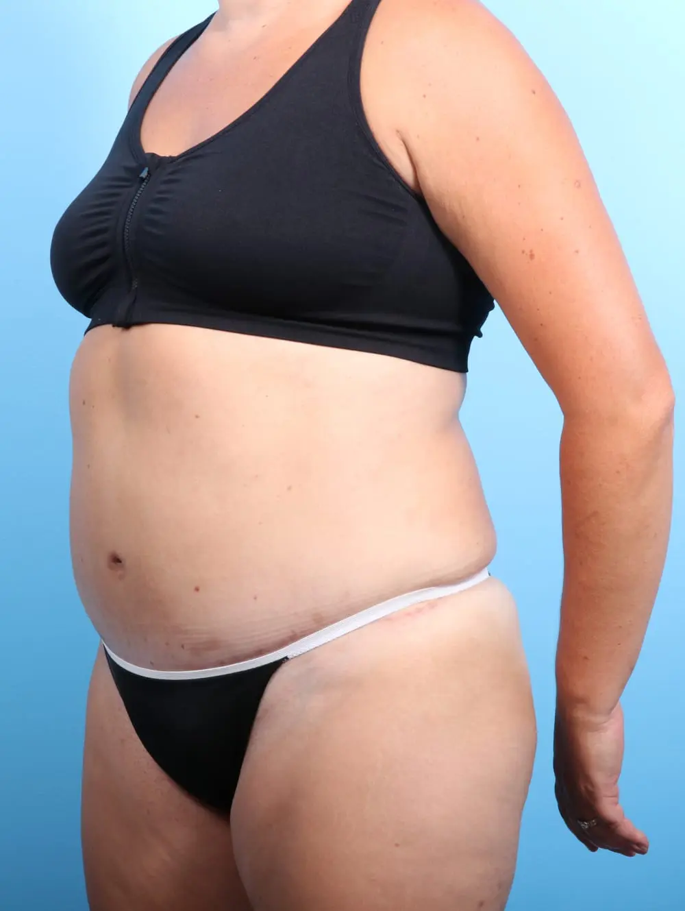 Tummy Tuck Patient Photo - Case 16968 - after view-1