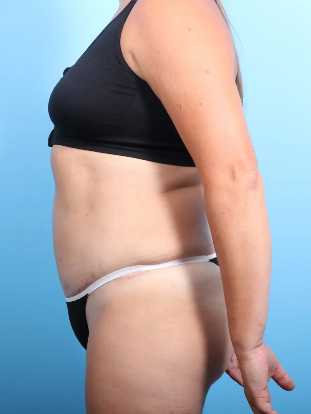 Tummy Tuck Patient Photo - Case 16968 - after view-2