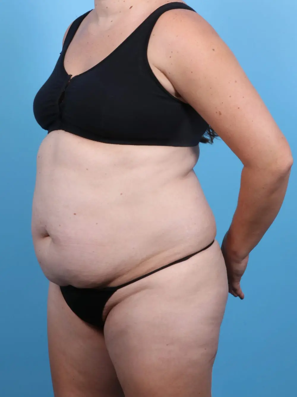 Tummy Tuck Patient Photo - Case 16968 - before view-1