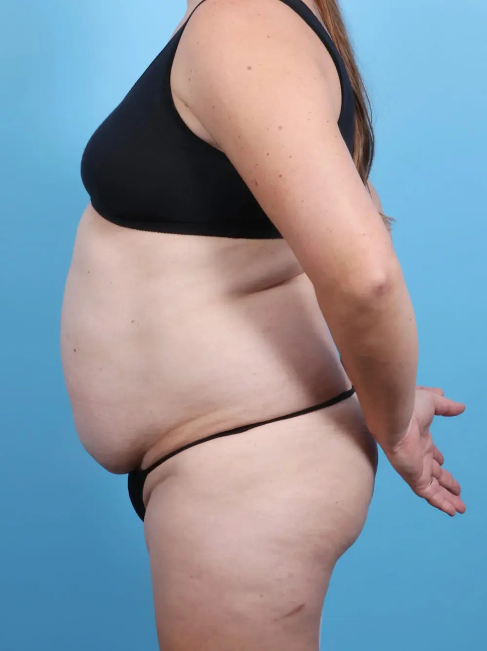 Tummy Tuck Patient Photo - Case 16968 - before view-2
