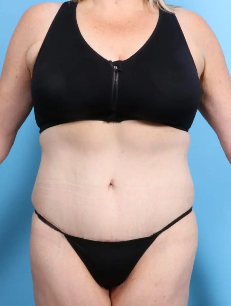 After Weight Loss - Case 16982 - After