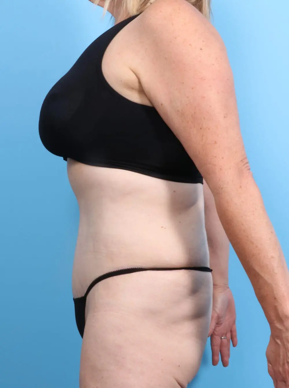 After Weight Loss Patient Photo - Case 16982 - after view-2