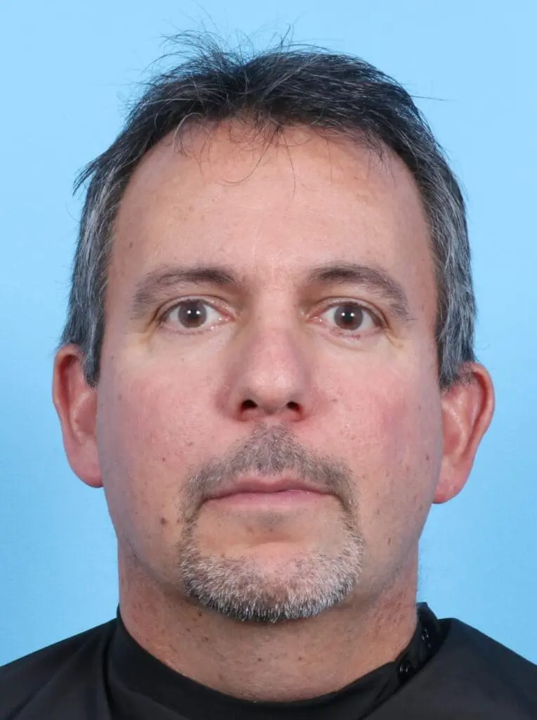 Facelift / Neck Lift - Case 17003 - Before