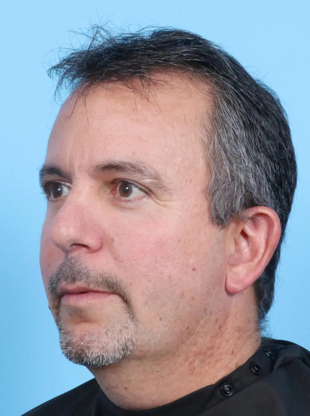 Facelift / Neck Lift Patient Photo - Case 17003 - before view-1