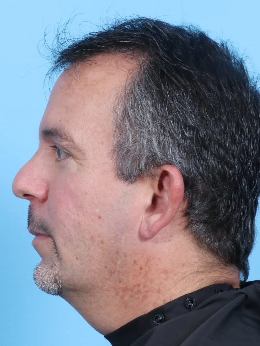 Facelift / Neck Lift Patient Photo - Case 17003 - before view-2