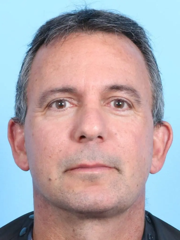 Facelift / Neck Lift - Case 17003 - After