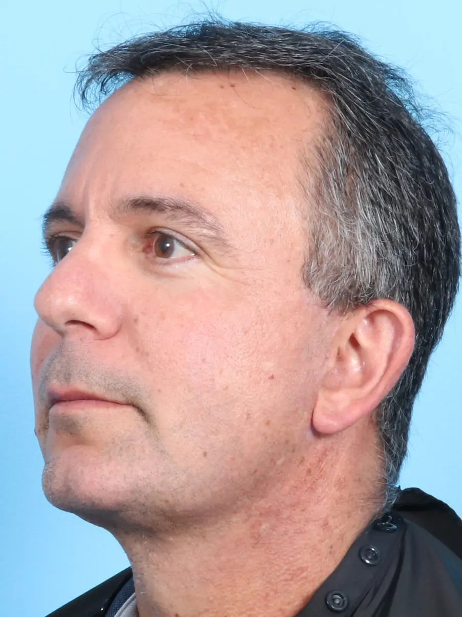 Facelift / Neck Lift Patient Photo - Case 17003 - after view-1
