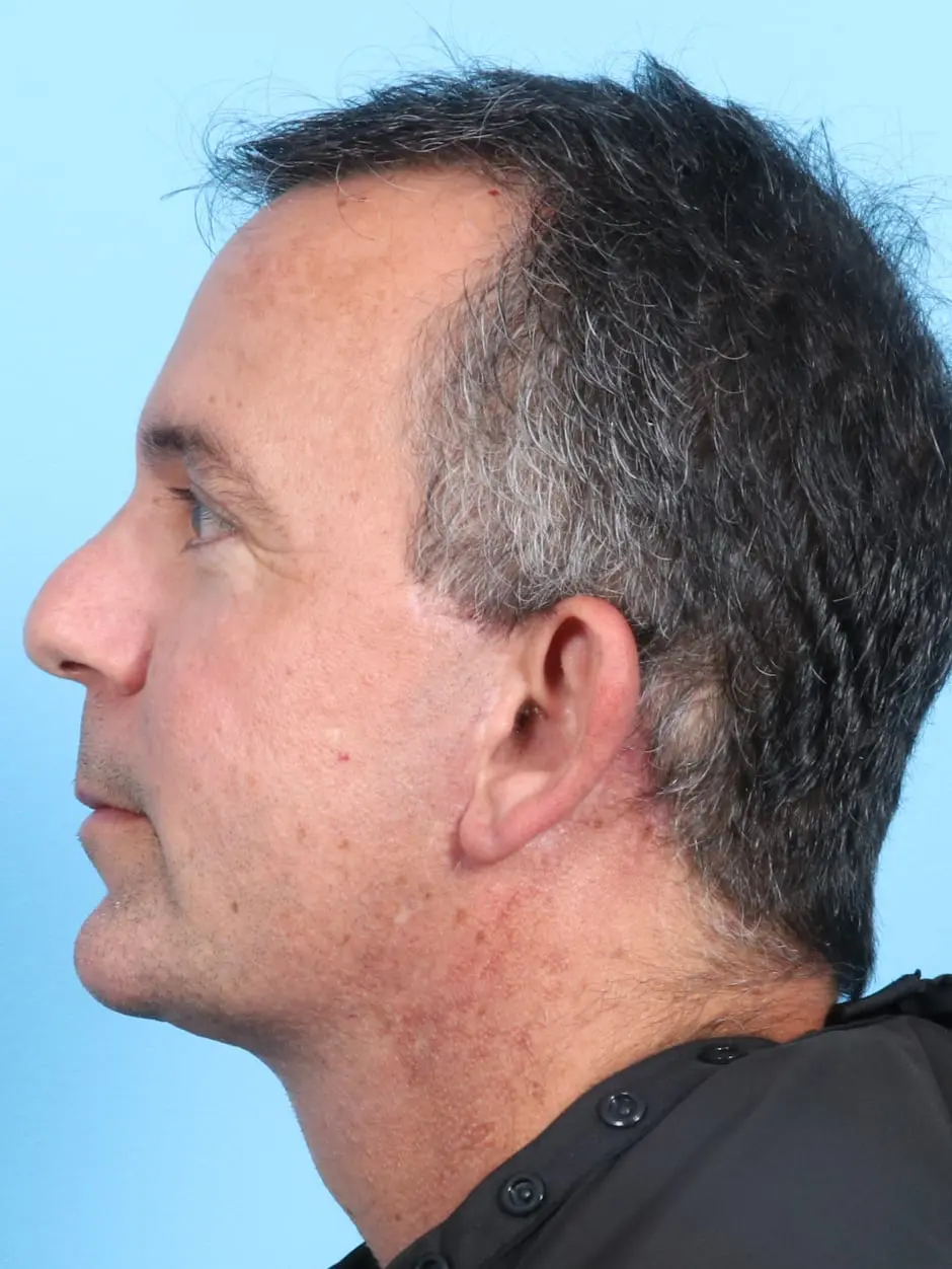 Facelift / Neck Lift Patient Photo - Case 17003 - after view-2