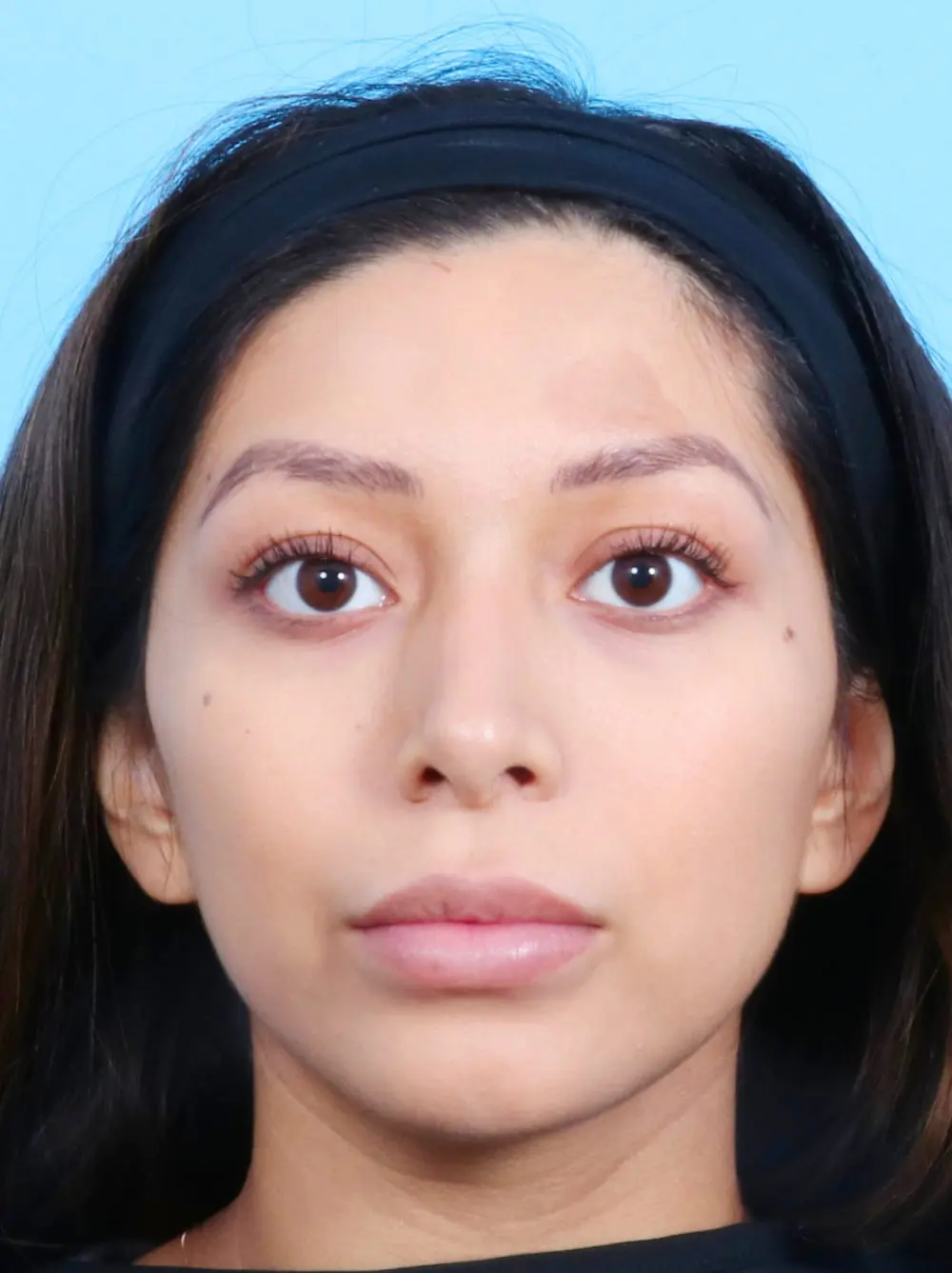 Rhinoplasty Patient Photo - Case 17014 - after view-1