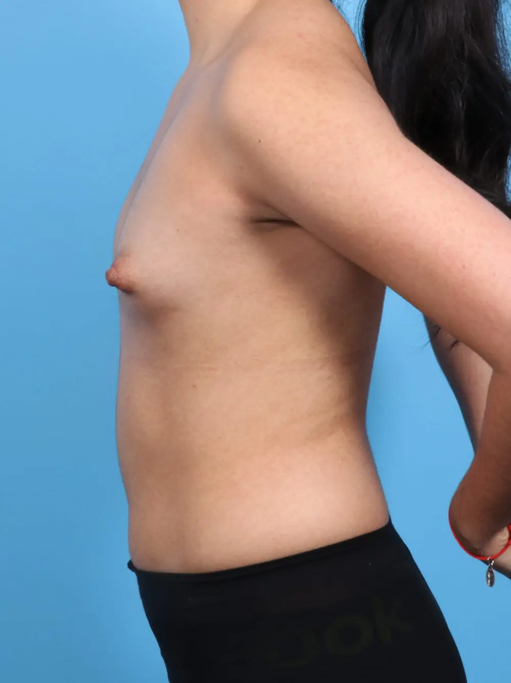 Breast Augmentation Patient Photo - Case 17098 - before view-2